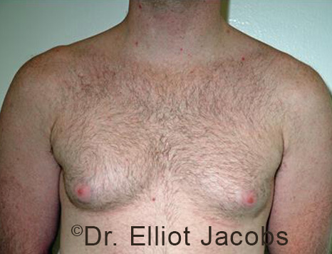 Male breast, before Gynecomastia treatment, front view, patient 96