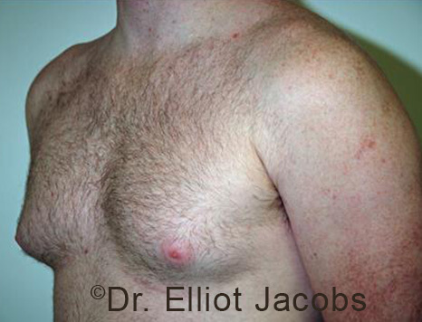 Male breast, before Gynecomastia treatment, l-side oblique view - patient 96