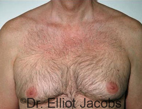 Male breast, before Gynecomastia treatment, front view, patient 26