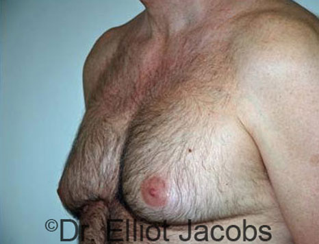 Male breast, before Gynecomastia treatment, l-side oblique view - patient 26