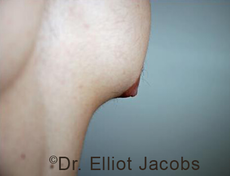 Male nipple, before Puffy Nipple treatment, r-side oblique view - patient 32