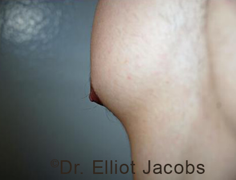 Male nipple, before Puffy Nipple treatment, l-side oblique view - patient 32