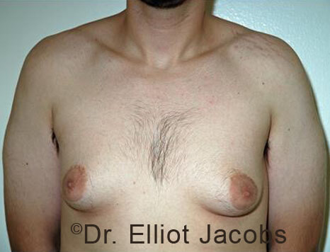 Men's breast, before Gynecomastia Adolescent treatment, front view - patient 35