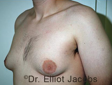 Men's breast, before Gynecomastia Adolescent treatment, oblique view - patient 35