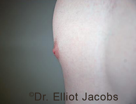 Male nipple, before Puffy Nipple treatment, r-side oblique view - patient 33