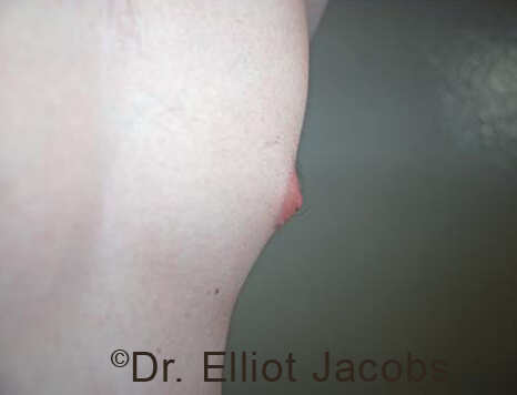 Male nipple, before Puffy Nipple treatment, l-side oblique view - patient 33