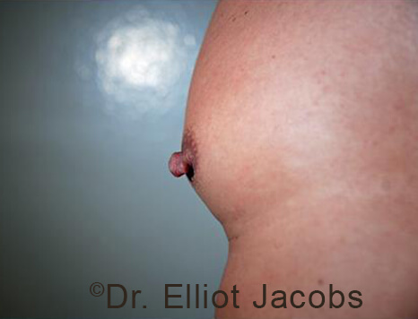 Male nipple, before Puffy Nipple treatment, oblique view - patient 51