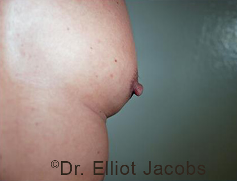 Male nipple, before Puffy Nipple treatment, side view - patient 51