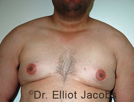 Male breast, before Gynecomastia treatment, front view, patient 97