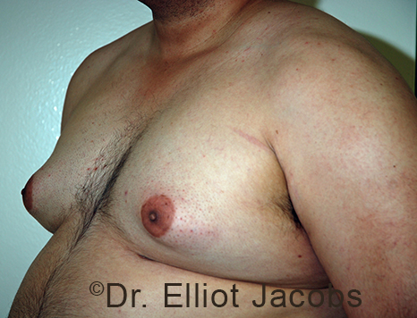 Male breast, before Gynecomastia treatment, l-side oblique view - patient 97