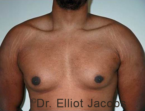 Male breast, before Gynecomastia treatment, front view, patient 98