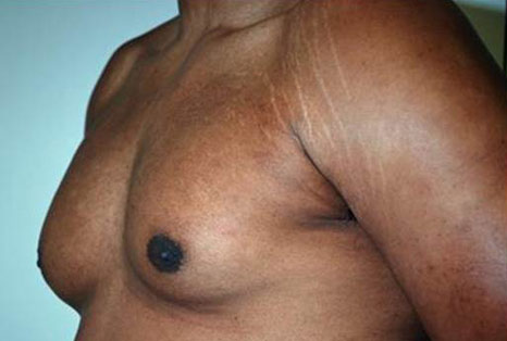Male breast, before gynecomastia treatment, l-side oblique view, patient 265
