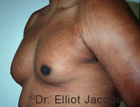 Male breast, before Gynecomastia treatment, l-side oblique view - patient 98