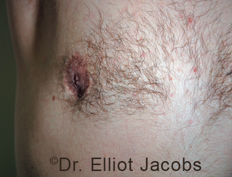 Men's breast, before Crater Deformity Repair treatment, front view - patient 4