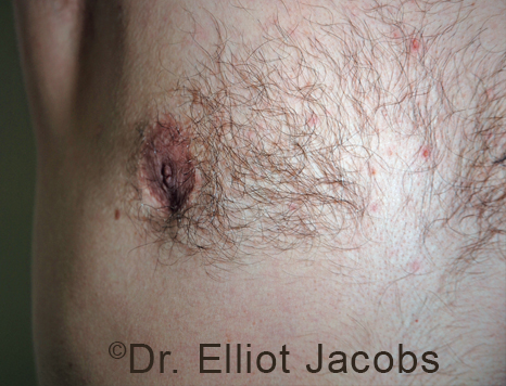 Men's breast, before Crater Deformity Repair treatment, front view - patient 4