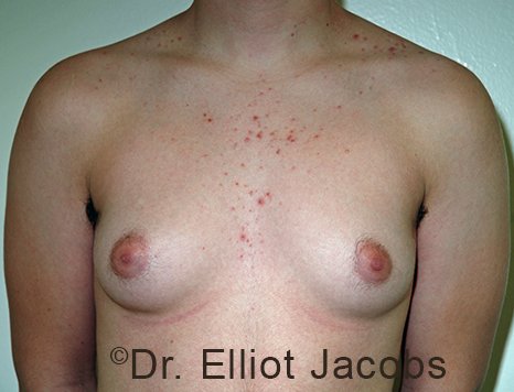Gynecomastia. Male breast, before FTM Top Surgery treatment, front view, patient 1
