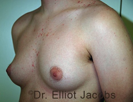 Gynecomastia. Male breast, before FTM Top Surgery treatment, l-side oblique view, patient 1