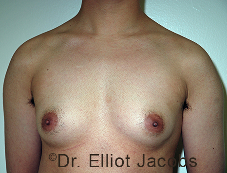 Gynecomastia. Male breast, before FTM Top Surgery treatment, front view, patient 2