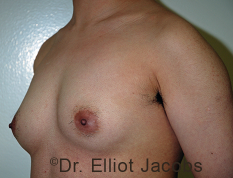 Gynecomastia. Male breast, before FTM Top Surgery treatment, l-side oblique view, patient 2