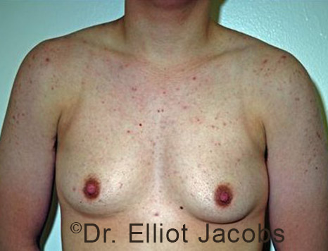 Male breast, before FTM Top Surgery treatment, front view, patient 2