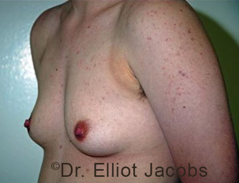 Gynecomastia. Male breast, before FTM Top Surgery treatment, l-side oblique view, patient 3