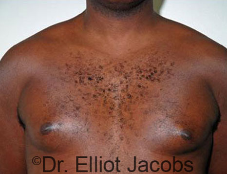 Male breast, before Gynecomastia treatment, front view, patient 27