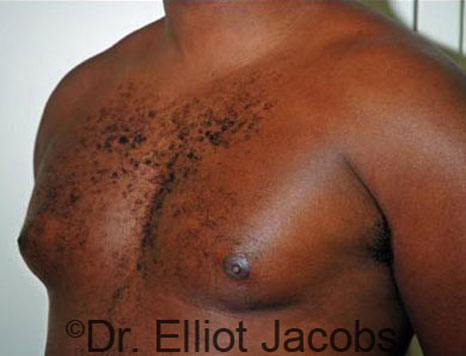 Male breast, before Gynecomastia treatment, l-side oblique view - patient 27