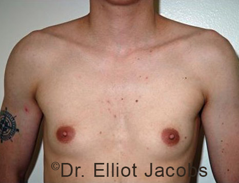 Gynecomastia. Male breast, before FTM Top Surgery treatment, front view, patient 4