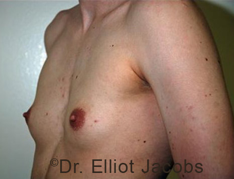 Gynecomastia. Male breast, before FTM Top Surgery treatment, l-side oblique view, patient 4