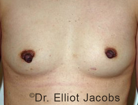 Gynecomastia. Male breast, before FTM Top Surgery treatment, front view, patient 5