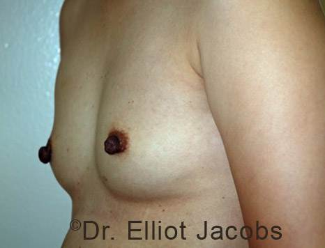 Gynecomastia. Male breast, before FTM Top Surgery treatment, l-side oblique view, patient 5