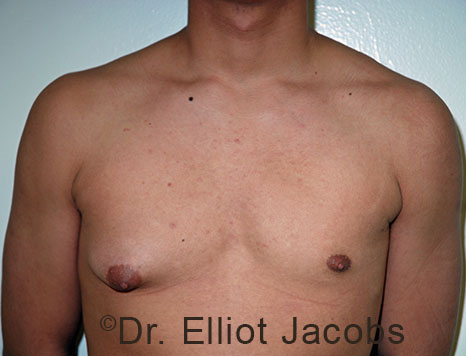 Male breast, before Gynecomastia treatment, front view, patient 99