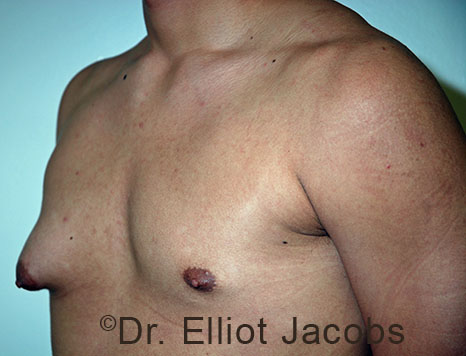 Male breast, before Gynecomastia treatment, l-side oblique view - patient 99