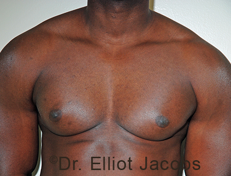 Male breast, before Gynecomastia treatment, front view, patient 100