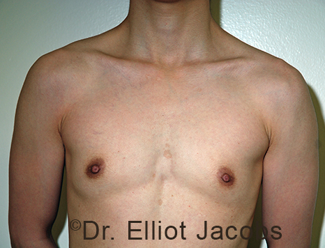 Gynecomastia. Male breast, before FTM Top Surgery treatment, front view, patient 6