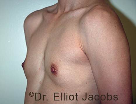 Gynecomastia. Male breast, before FTM Top Surgery treatment, l-side oblique view, patient 6