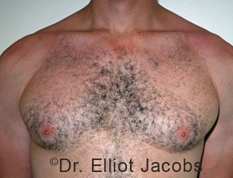 Male breast, before Gynecomastia treatment, front view, patient 101