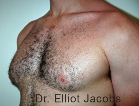 Male breast, before Gynecomastia treatment, l-side oblique view - patient 101