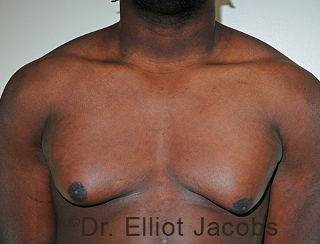 Male breast, before Gynecomastia treatment, front view, patient 102