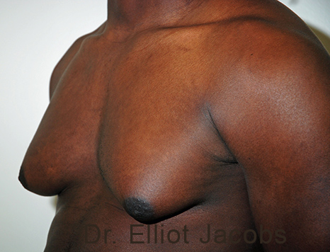 Male breast, before Gynecomastia treatment, l-side oblique view - patient 102