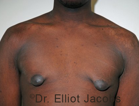 Male breast, before Gynecomastia treatment, front view, patient 103