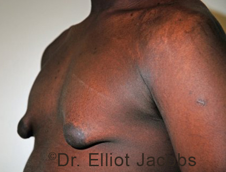 Male breast, before Gynecomastia treatment, l-side oblique view - patient 103