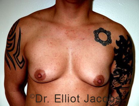 Gynecomastia. Male breast, before FTM Top Surgery treatment, front view, patient 7