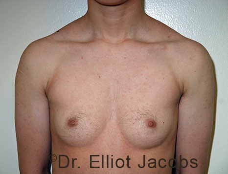 Gynecomastia. Male breast, before FTM Top Surgery treatment, front view, patient 8