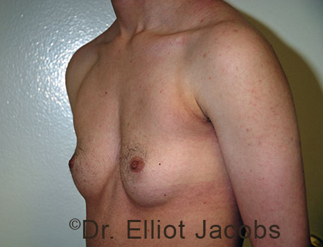 Male breast, before FTM Top Surgery treatment, oblique view, patient 1