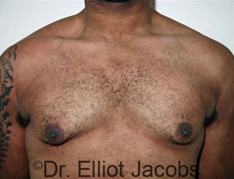 Male breast, before Gynecomastia treatment, front view, patient 28