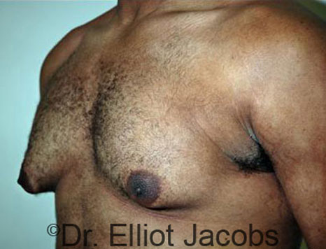 Male breast, before Gynecomastia treatment, l-side oblique view - patient 28