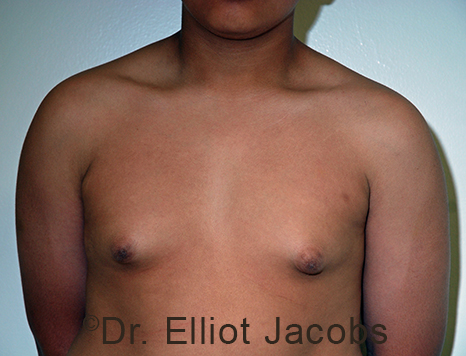 Men's breast, before Gynecomastia Adolescent treatment, front view - patient 36