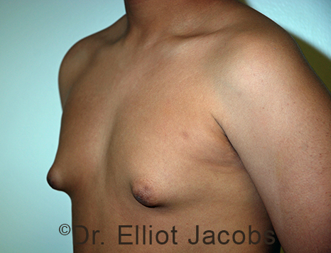 Men's breast, before Gynecomastia Adolescent treatment, oblique view - patient 36