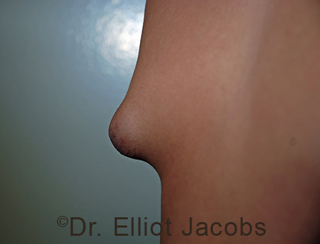 Male nipple, before Puffy Nipple treatment, l-side oblique view - patient 35